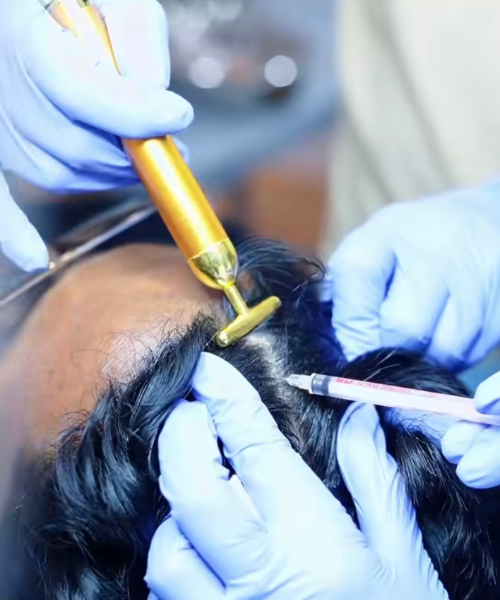 GFC hair treatment in Yelahanka Bangalore for hair loss and hair regrowth at Perfect U Clinic